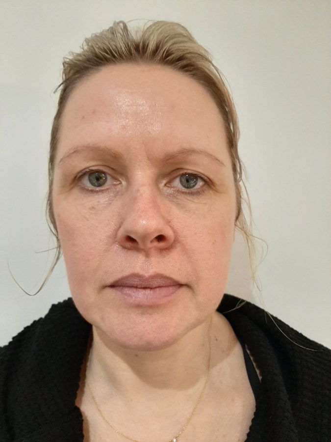 Katie after eight EnerQi treatments