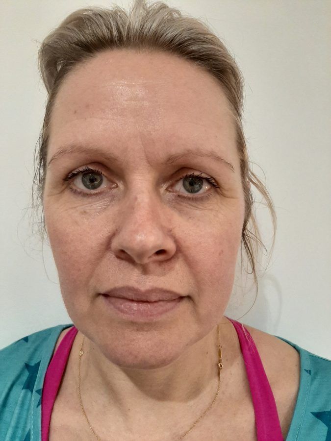 Katie before her first EnerQi treatment